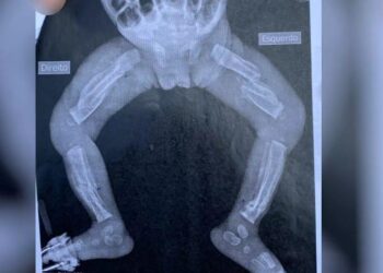 Bebê de 6 meses agredida pelos pais não tem previsão de alta, em Goiânia