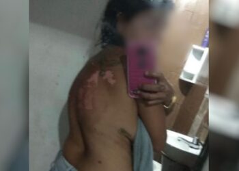 Mulher tem corpo queimado com óleo quente após briga por ciúmes, em Santa Helena 