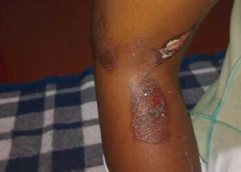 Policia Civil procura por mãe suspeita de queimar criança de 8 anos