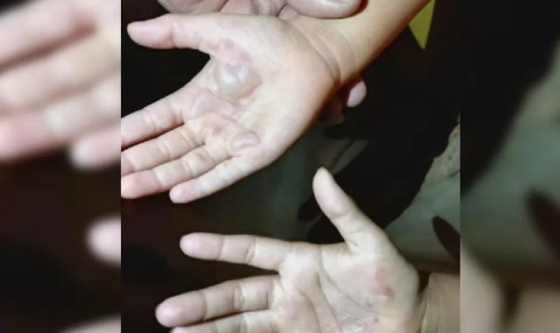 Mãe é investigada por queimar a mão das filhas como castigo, em Rio Verde