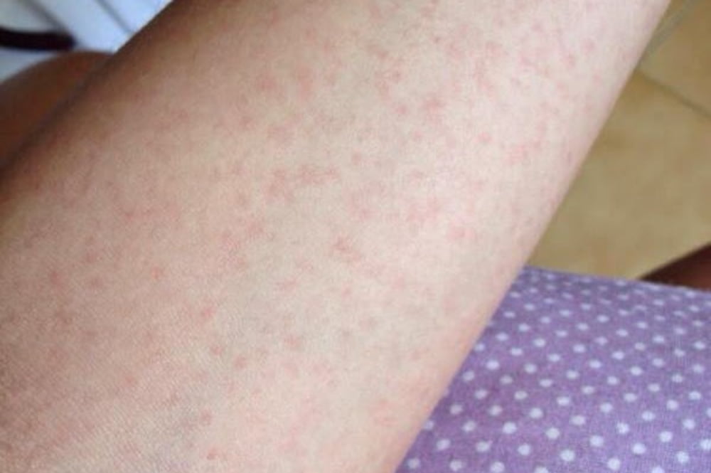 Goiânia e Aparecida estão entre as três cidades com mais casos de dengue no Brasil