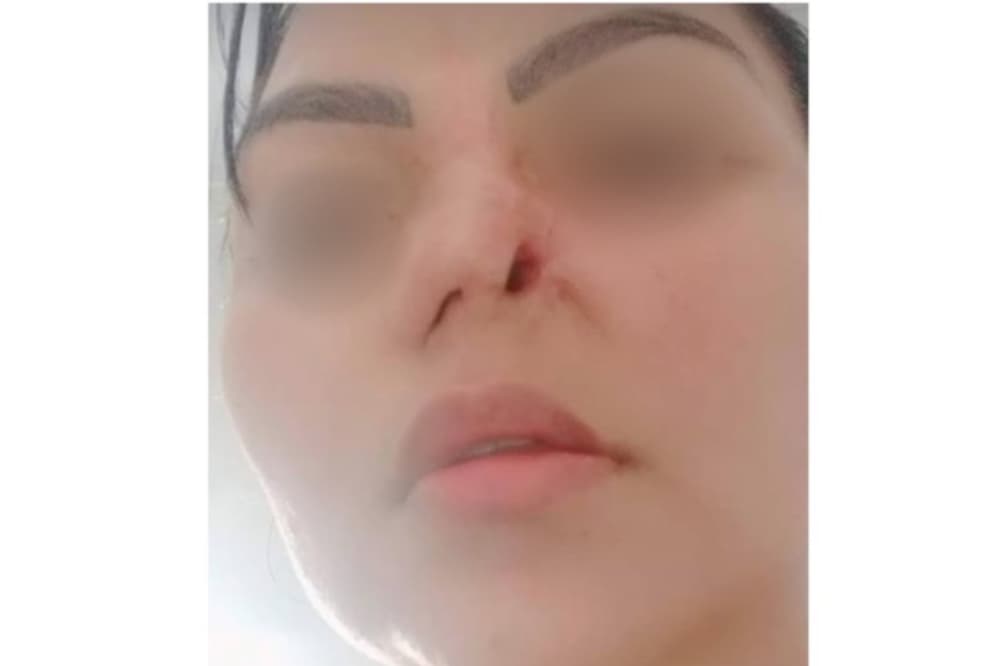 Dentista é indiciado após mulher perder parte do nariz em cirurgia estética, em Aparecida