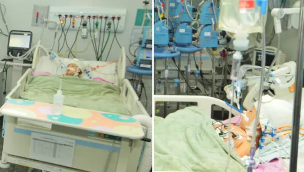 Gêmea siamesa separada em Goiânia tem piora e seu quadro é gravíssimo, diz boletim