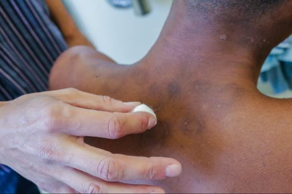 SUS irá receber testes rápidos para hanseníase desenvolvidos pela UFG