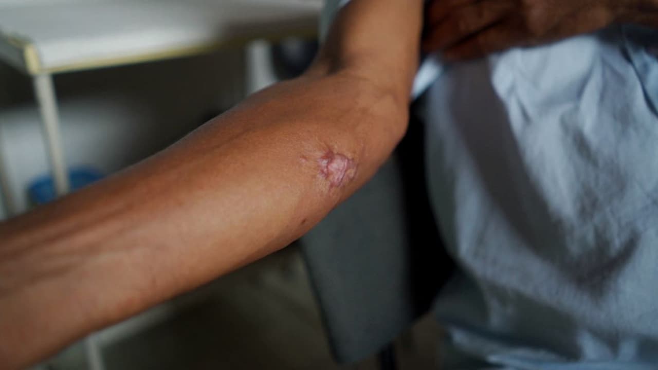 sintomas de leishmaniose visceral