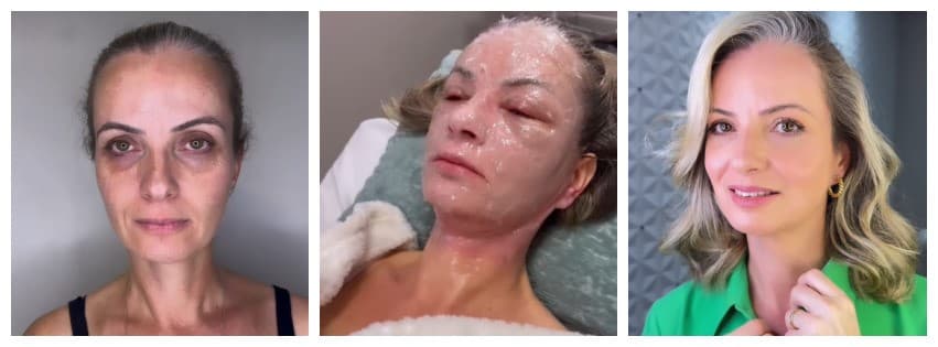 Pesquisa revela os melhores especialistas em peeling de fenol no Brasil