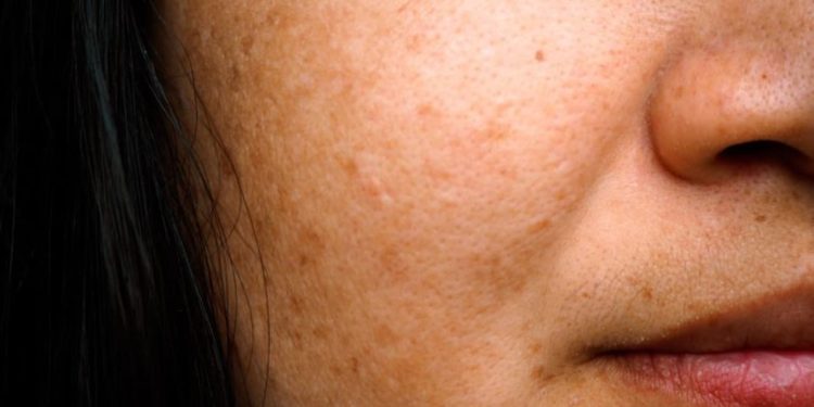 Conheça os 5 melhores especialistas em melasma no Brasil