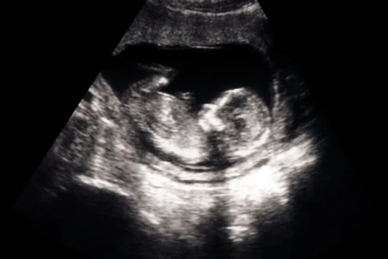 Casos de aborto
