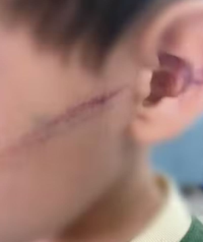 Criança agredida pela mãe