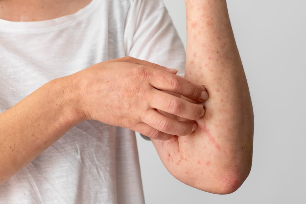 Sintomas de dengue