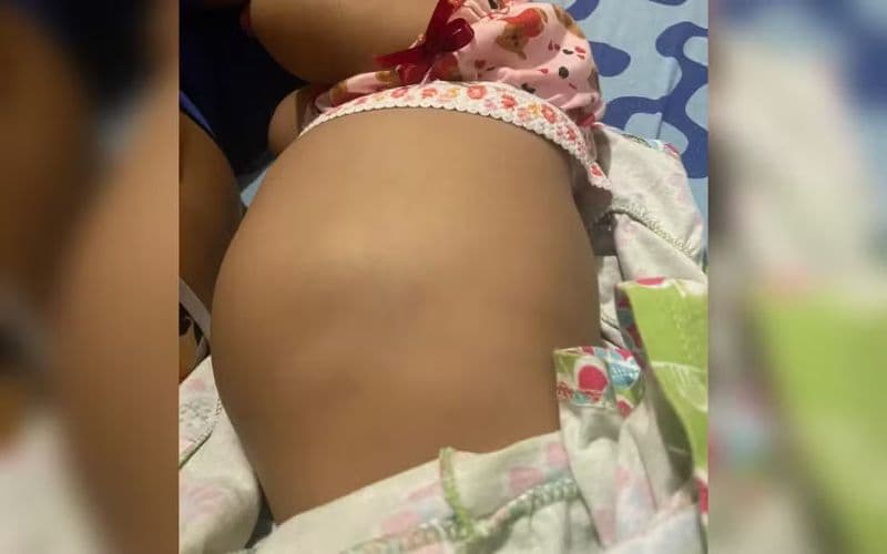 Suspeita de tumor na barriga