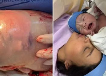 Confira o momento em que bebê nasce empelicado em hospital de Goiás