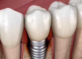 Como é feita a cirurgia de implante dentário em Belo Horizonte: um guia completo